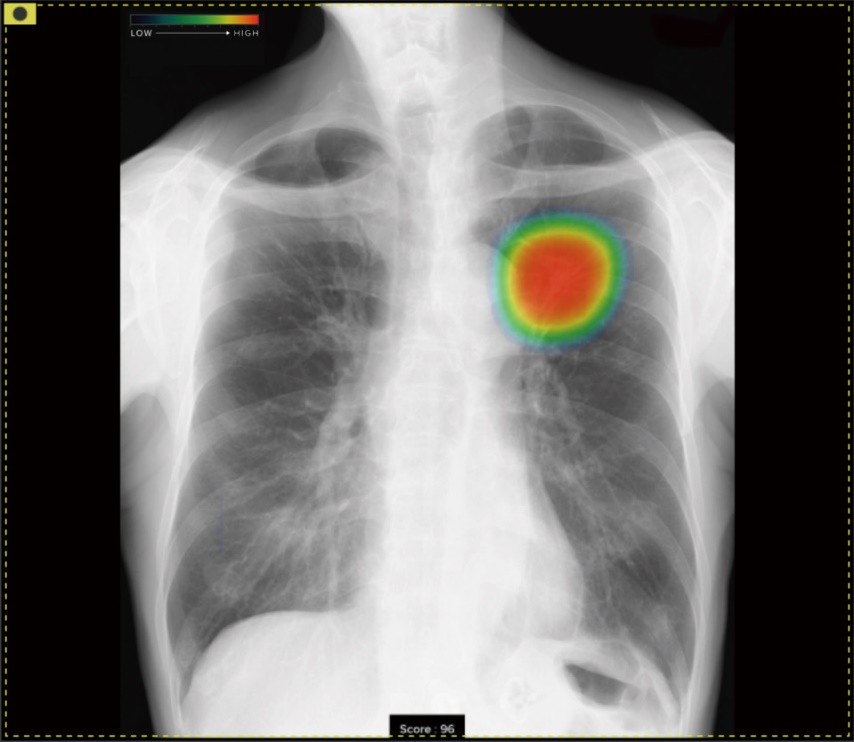 胸部X線の画像を自動解析